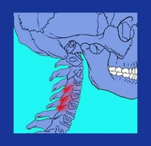 Cervical Facet Syndrome Neck Pain