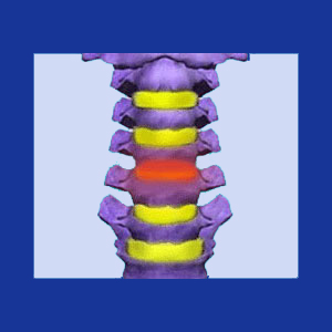 Cervical Disc Surgery