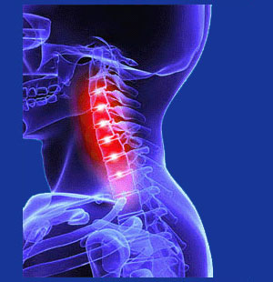 Osteoarthritis in the Cervical Spine - Neck Pain